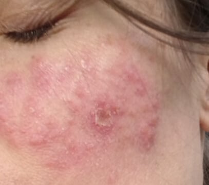 Ronja aus Bayern · Rosacea - Vor der DemoDerm Anwendung