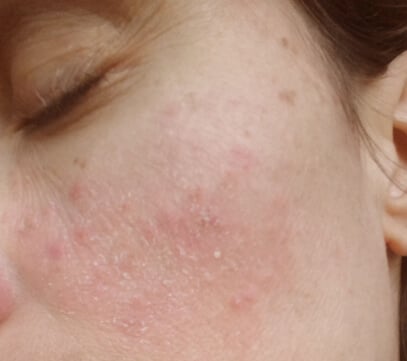 Ronja aus Bayern · Rosacea - Nach 6 Wochen DemoDerm Anwendung