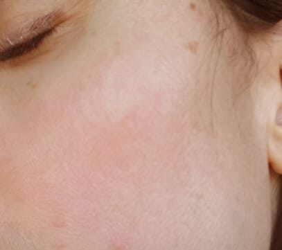 Ronja aus Bayern · Rosacea - Nach 12 Wochen DemoDerm Anwendung