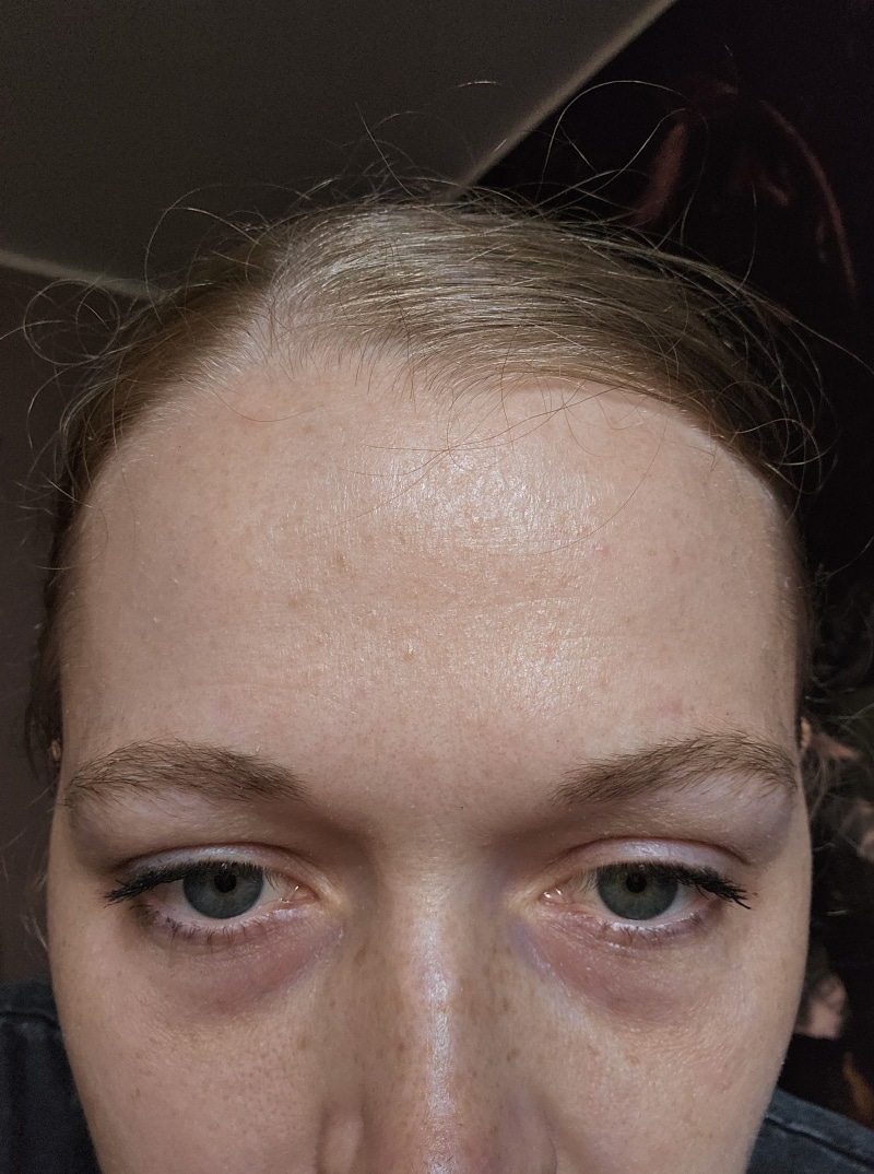 Jenny aus Österreich · Rosacea Bilder & Fotos - Jenny aus Wien - Nach 6 Monaten Anwendung von DemoDerm