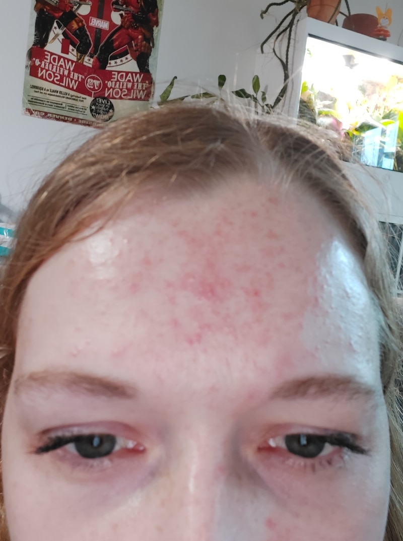 Jenny aus Österreich · Rosacea Bilder & Fotos - Jenny aus Wien - Vor der Anwendung von DemoDerm