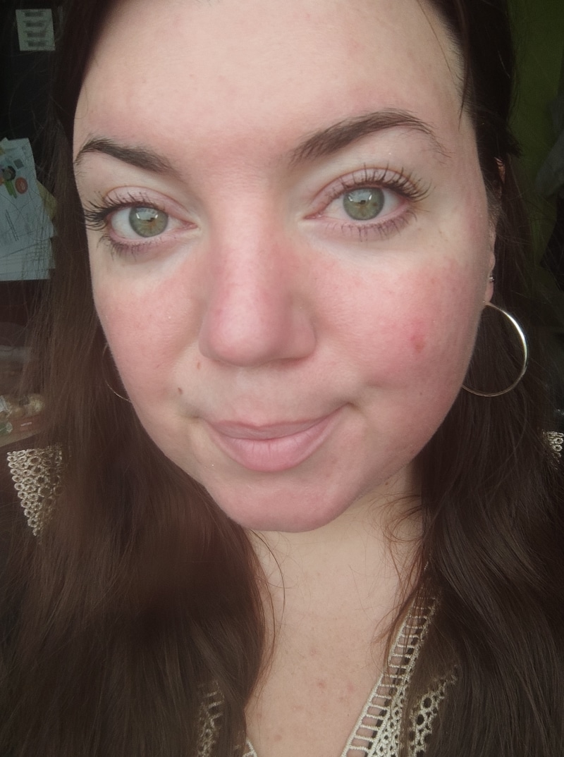 Tanja · Rosacea Bilder & Fotos - Tanja - Nach 1 Monat Anwendung von DemoDerm