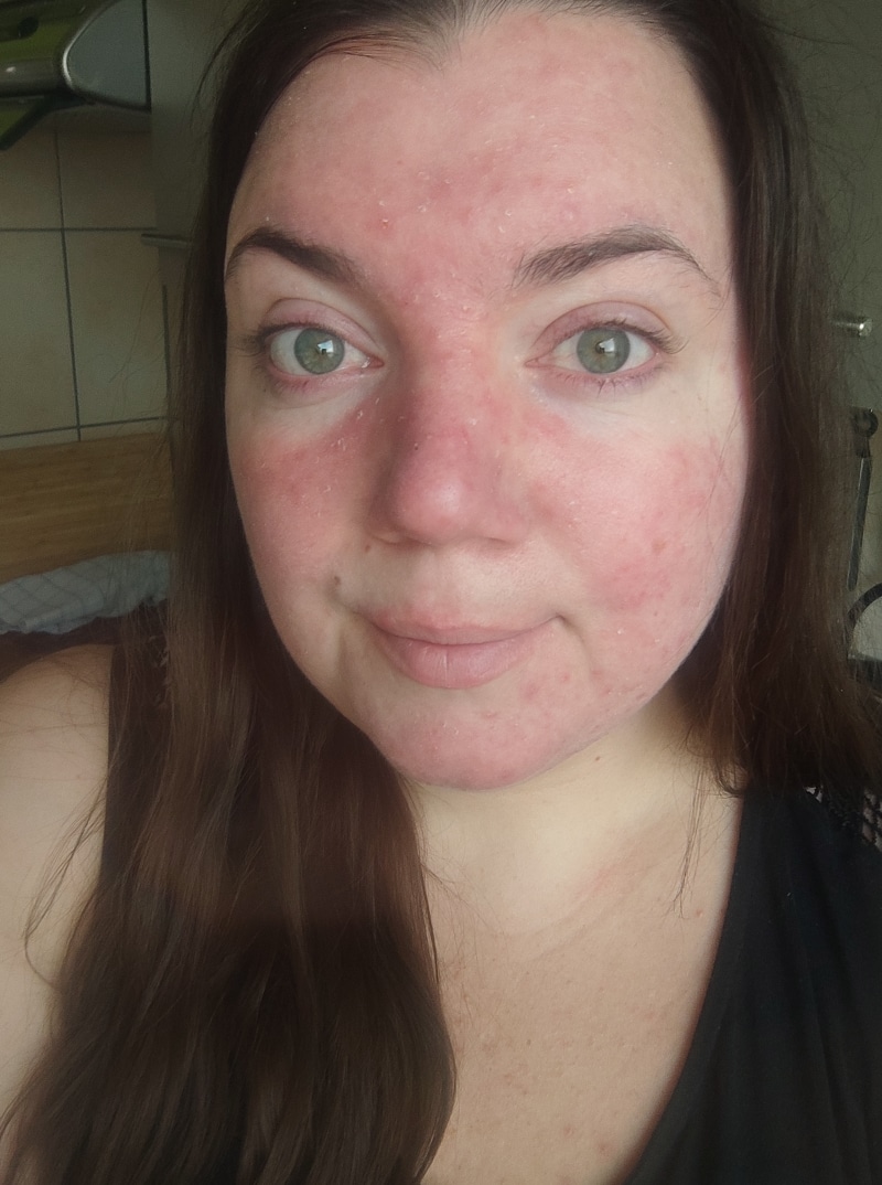 Tanja · Rosacea Bilder & Fotos - Tanja - Nach 5 Tagen Anwendung von DemoDerm