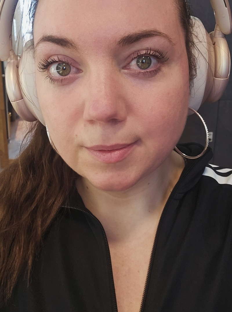 Tanja · Rosacea Bilder & Fotos - Tanja - Nach 9 Monaten - DemoDerm