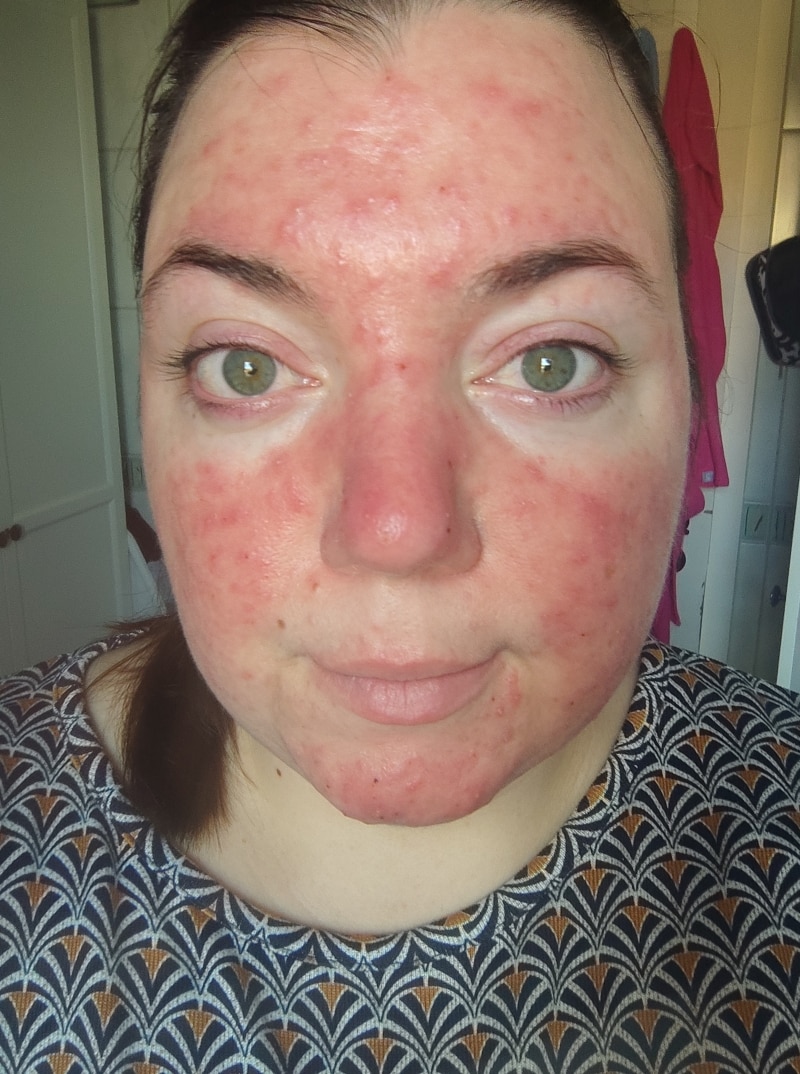 Tanja · Rosacea Bilder & Fotos - Tanja - Vor der Anwendung von DemoDerm