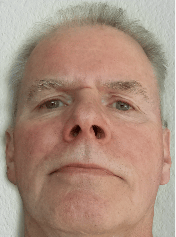 Herr O.S. aus Niedersachsen · Rosacea Bilder & Fotos - Herr O.S. aus Niedersachsen - Nach vier Wochen Anwendung von DemoDerm