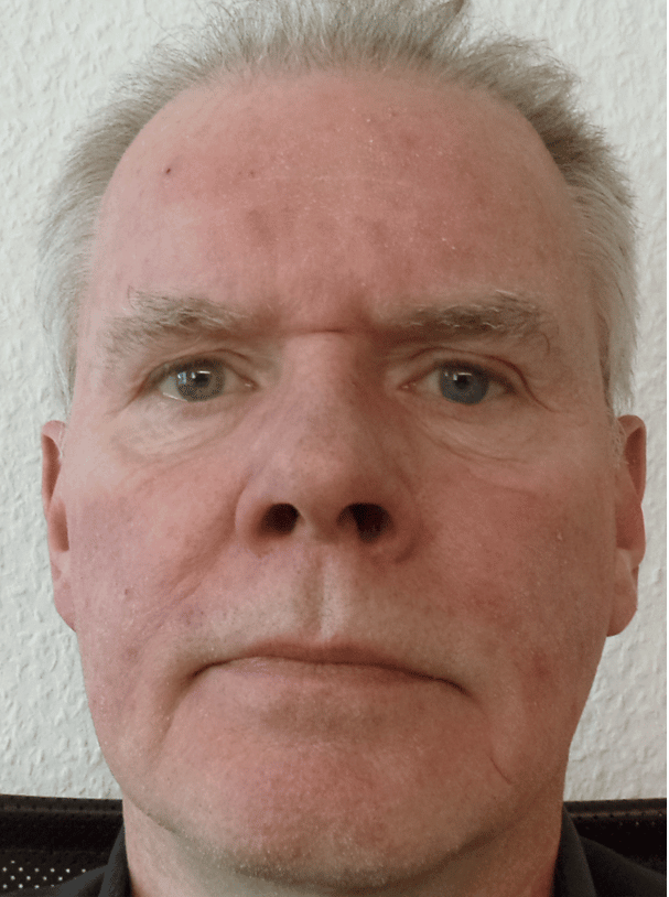 Herr O.S. aus Niedersachsen · Rosacea Bilder & Fotos - Herr O.S. aus Niedersachsen - Nach zwei Wochen Anwendung von DemoDerm