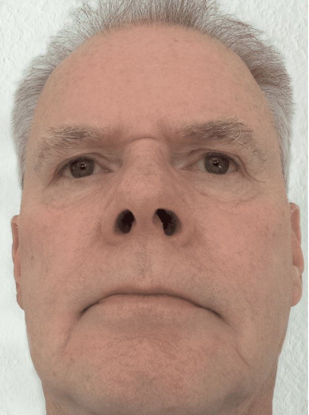 Herr O.S. aus Niedersachsen · Rosacea Bilder & Fotos - Herr O.S. aus Niedersachsen - Nach 12 Monaten Anwendung von DemoDerm