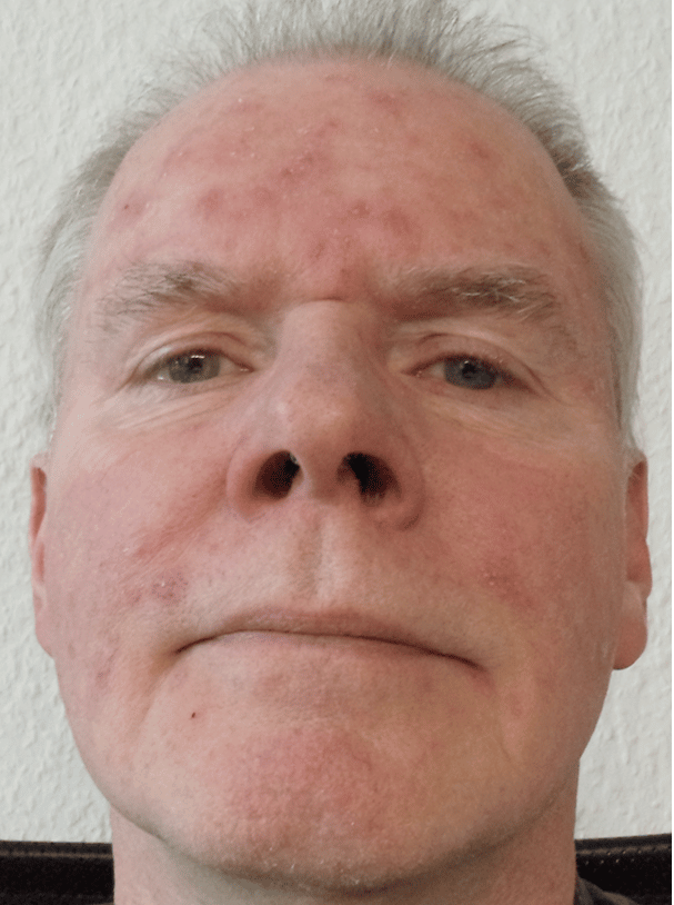 Herr O.S. aus Niedersachsen · Rosacea Bilder & Fotos - Herr O.S. aus Niedersachsen - Vor der Anwendung von DemoDerm