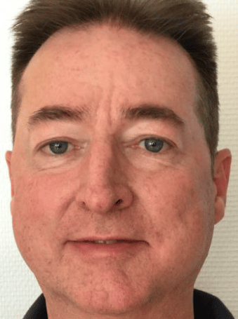 Theo aus Bonn (Name geändert) · Rosacea Bilder & Fotos - Theo aus Bonn - Nach sechs Wochen Anwendung von DemoDerm