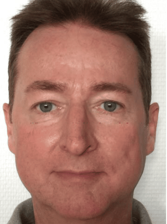 Theo aus Bonn (Name geändert) · Rosacea Bilder & Fotos - Theo aus Bonn - Nach 12 Monaten Anwendung von DemoDerm