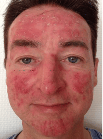 Theo aus Bonn (Name geändert) · Rosacea Bilder & Fotos - Theo aus Bonn - Vor der Anwendung von DemoDerm