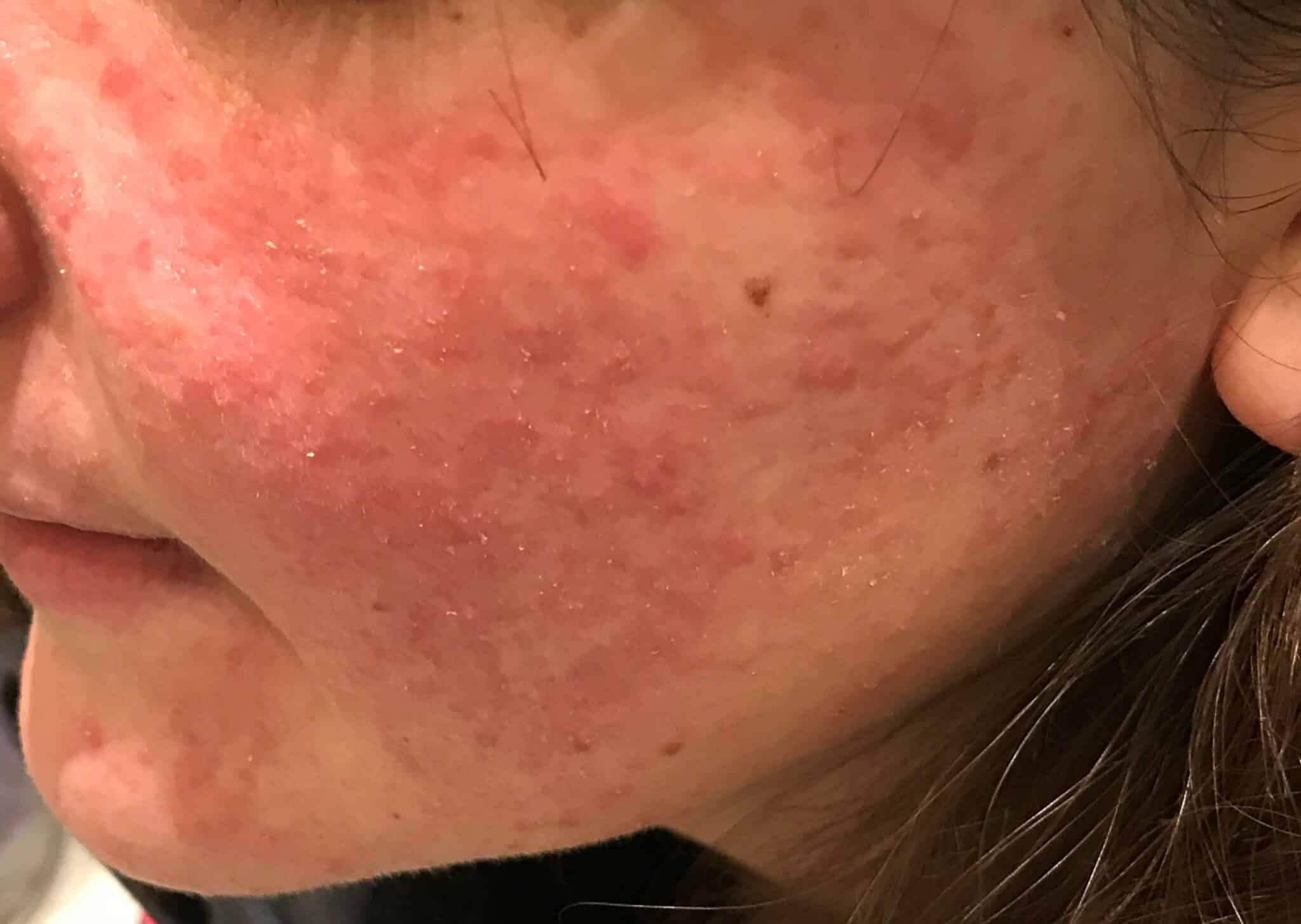 Historische Mikroskopieaufnahme des Kompetenzzentrums Akne – Rosacea (rosacea.si); keine Diagnose allein aus dem Bild