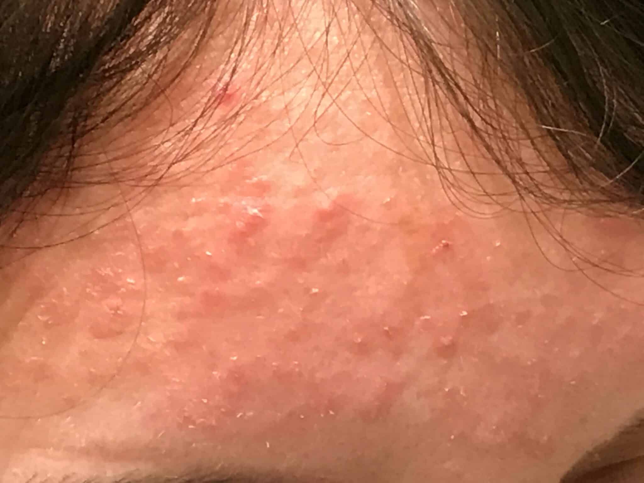 Historische Mikroskopieaufnahme des Kompetenzzentrums Akne – Rosacea (rosacea.si); keine Diagnose allein aus dem Bild